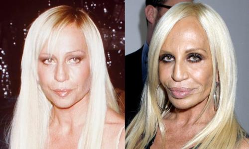Donatella Versace surgery before and after