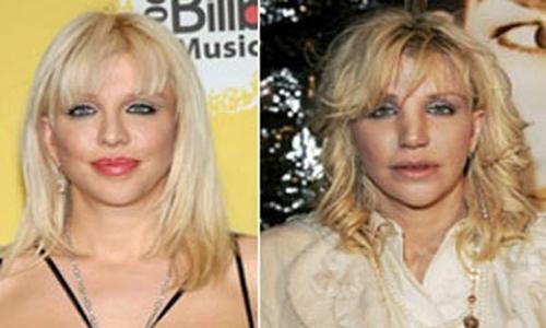 Courtney Love plastic surgery before and after