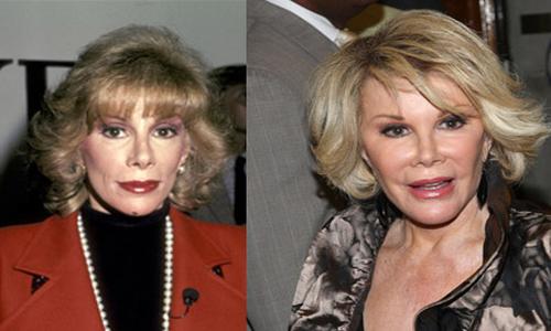 Joan Rivers plastic surgery disaster